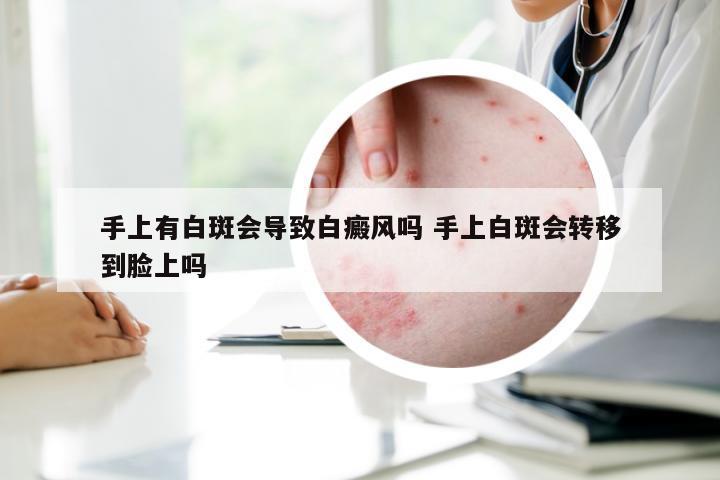 手上有白斑会导致白癜风吗 手上白斑会转移到脸上吗