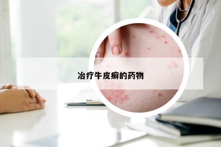 冶疗牛皮癣的药物