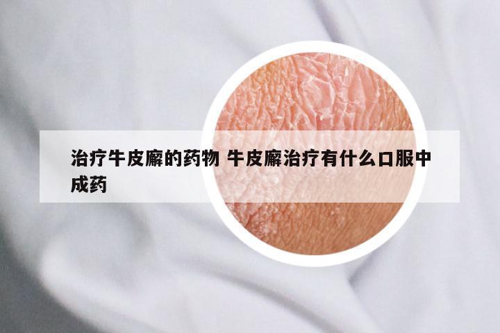 治疗牛皮廨的药物 牛皮廨治疗有什么口服中成药