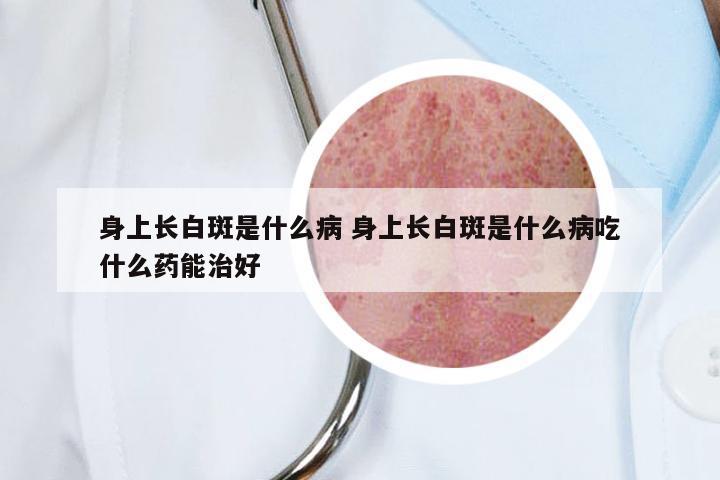 身上长白斑是什么病 身上长白斑是什么病吃什么药能治好