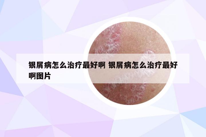 银屑病怎么治疗最好啊 银屑病怎么治疗最好啊图片