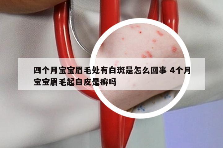 四个月宝宝眉毛处有白斑是怎么回事 4个月宝宝眉毛起白皮是癣吗