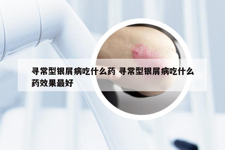 寻常型银屑病吃什么药 寻常型银屑病吃什么药效果最好