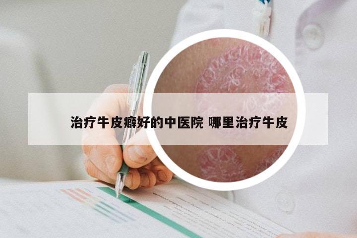 治疗牛皮癖好的中医院 哪里治疗牛皮