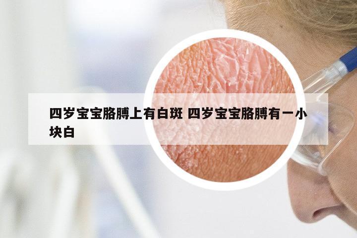 四岁宝宝胳膊上有白斑 四岁宝宝胳膊有一小块白