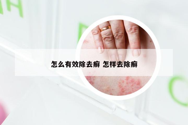 怎么有效除去癣 怎样去除癣