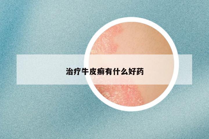 治疗牛皮癣有什么好药