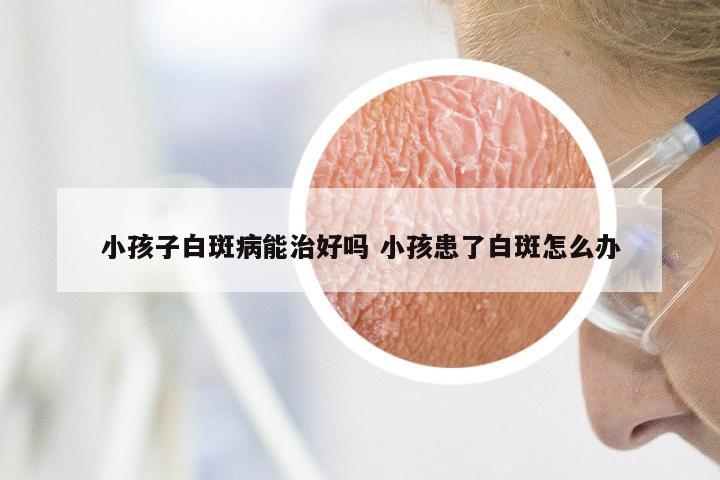 小孩子白斑病能治好吗 小孩患了白斑怎么办