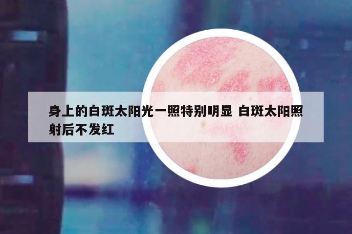 身上的白斑太阳光一照特别明显 白斑太阳照射后不发红