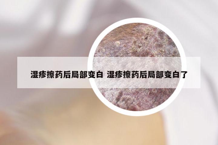 湿疹擦药后局部变白 湿疹擦药后局部变白了