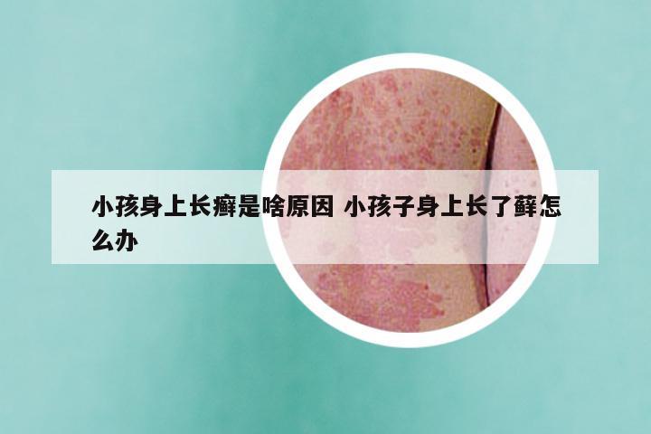 小孩身上长癣是啥原因 小孩子身上长了藓怎么办