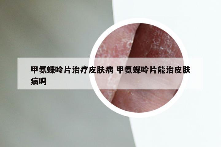 甲氨蝶呤片治疗皮肤病 甲氨蝶呤片能治皮肤病吗