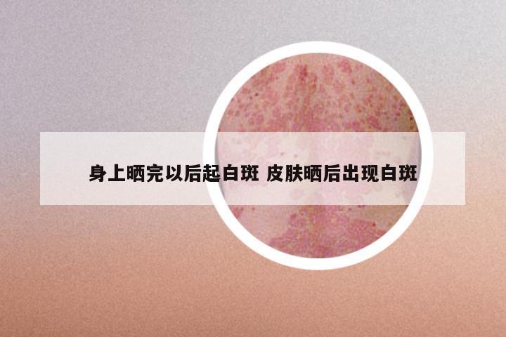 身上晒完以后起白斑 皮肤晒后出现白斑
