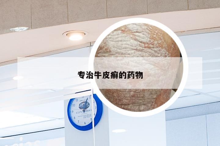 专治牛皮癣的药物