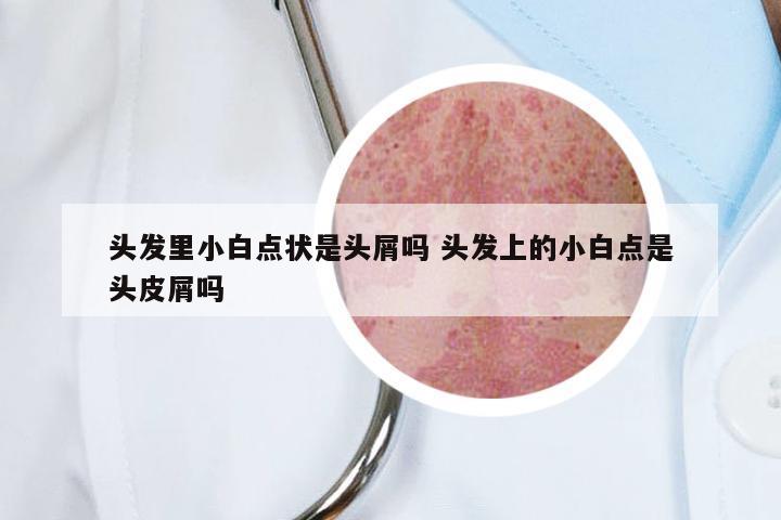 头发里小白点状是头屑吗 头发上的小白点是头皮屑吗