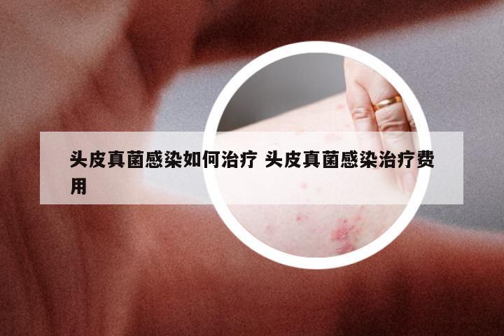 头皮真菌感染如何治疗 头皮真菌感染治疗费用