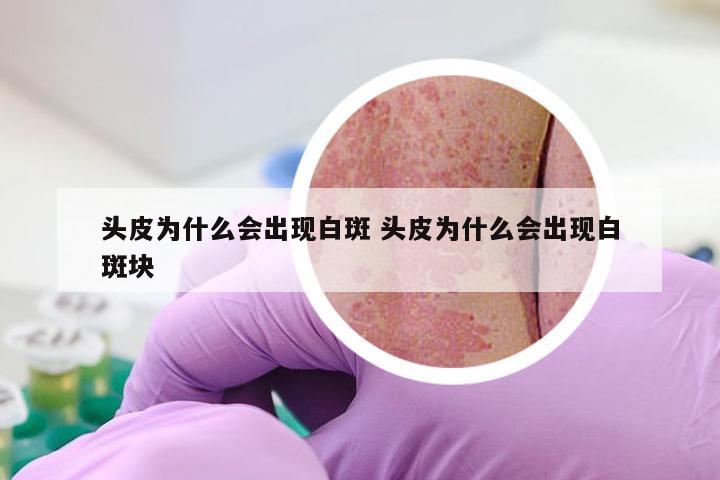 头皮为什么会出现白斑 头皮为什么会出现白斑块