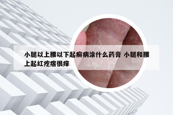小腿以上腰以下起癣病涂什么药膏 小腿和腰上起红疙瘩很痒
