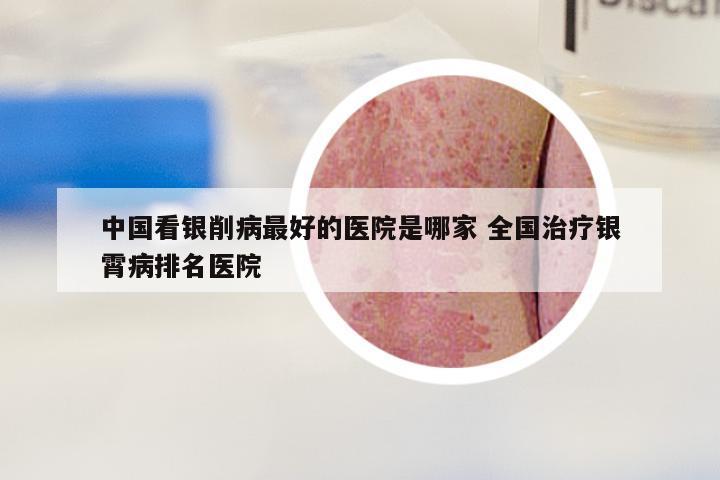 中国看银削病最好的医院是哪家 全国治疗银霄病排名医院