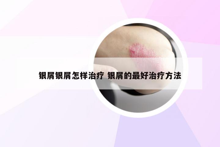 银屑银屑怎样治疗 银屑的最好治疗方法