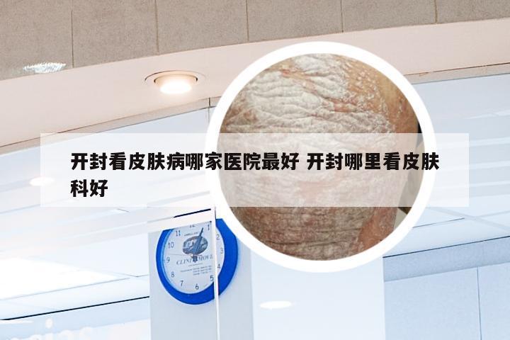 开封看皮肤病哪家医院最好 开封哪里看皮肤科好