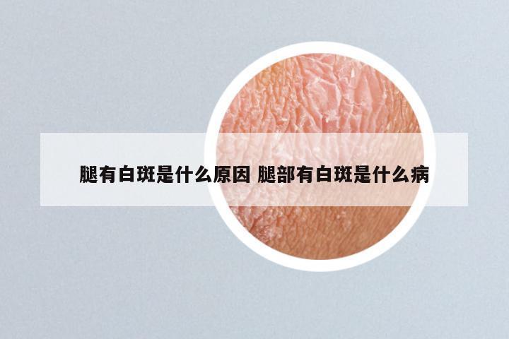 腿有白斑是什么原因 腿部有白斑是什么病