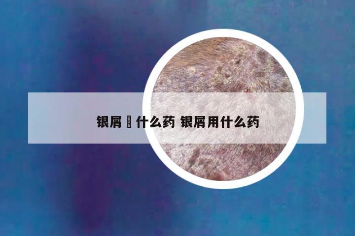 银屑暍什么药 银屑用什么药