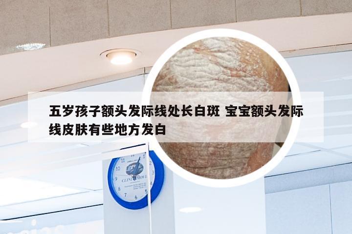 五岁孩子额头发际线处长白斑 宝宝额头发际线皮肤有些地方发白