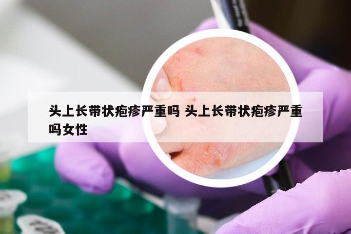 头上长带状疱疹严重吗 头上长带状疱疹严重吗女性