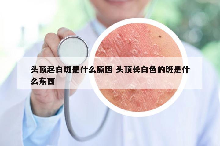 头顶起白斑是什么原因 头顶长白色的斑是什么东西