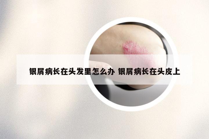 银屑病长在头发里怎么办 银屑病长在头皮上