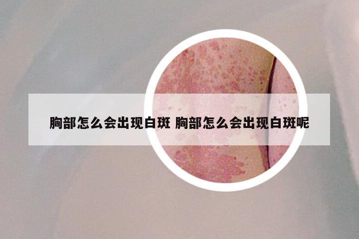 胸部怎么会出现白斑 胸部怎么会出现白斑呢