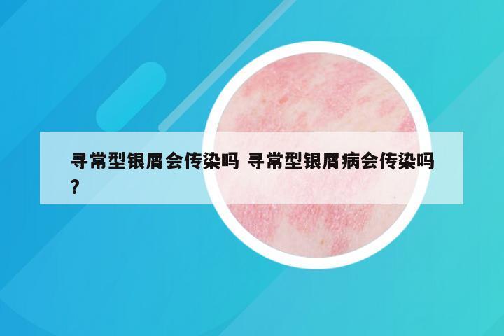 寻常型银屑会传染吗 寻常型银屑病会传染吗?