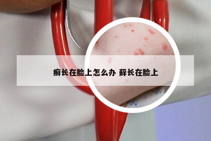 癣长在脸上怎么办 藓长在脸上