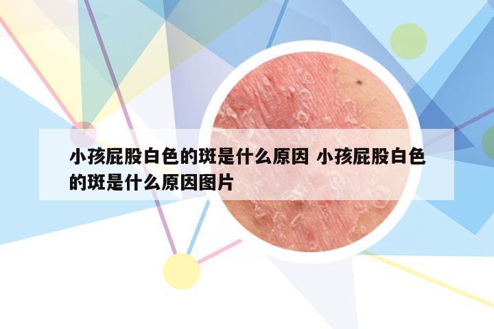 小孩屁股白色的斑是什么原因 小孩屁股白色的斑是什么原因图片