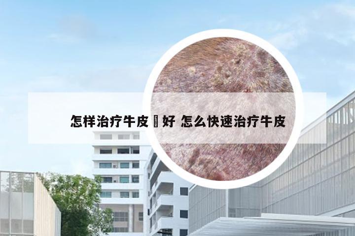 怎样治疗牛皮廯好 怎么快速治疗牛皮