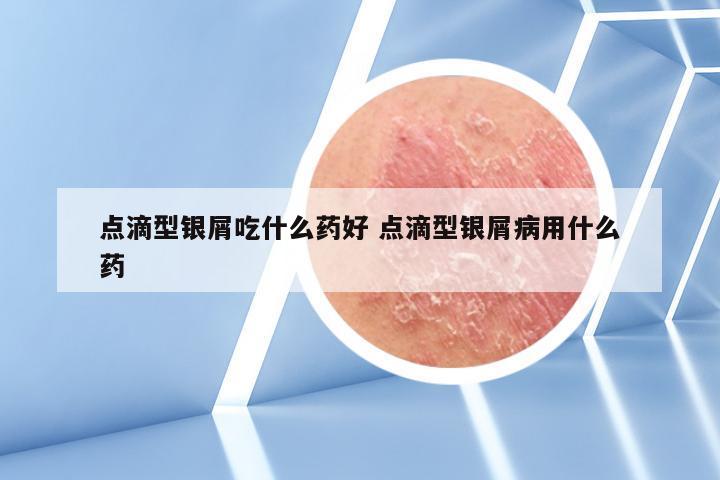 点滴型银屑吃什么药好 点滴型银屑病用什么药