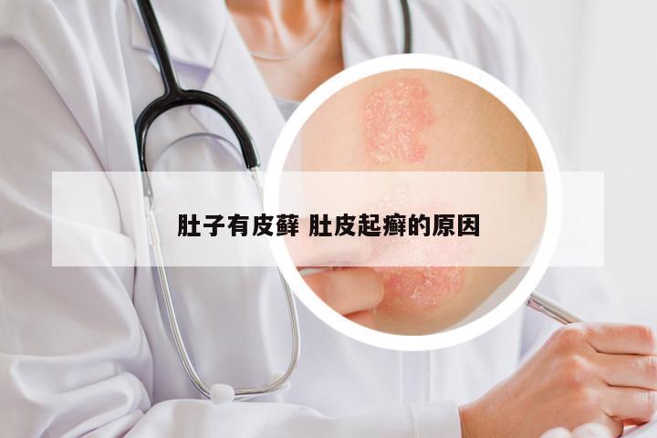 肚子有皮藓 肚皮起癣的原因