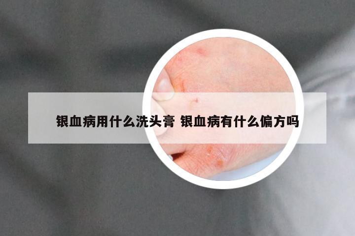 银血病用什么洗头膏 银血病有什么偏方吗