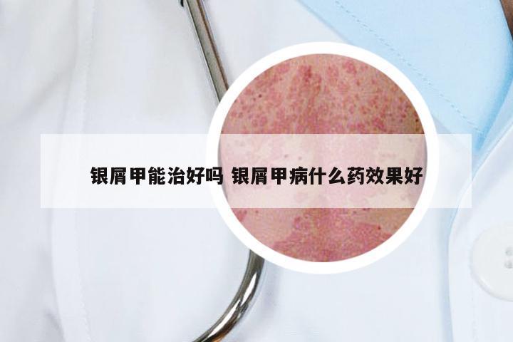 银屑甲能治好吗 银屑甲病什么药效果好
