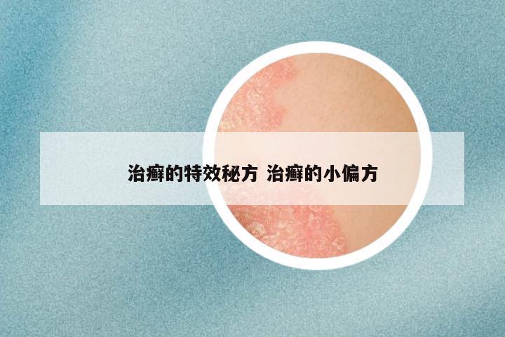 治癣的特效秘方 治癣的小偏方