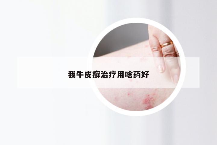 我牛皮癣治疗用啥药好