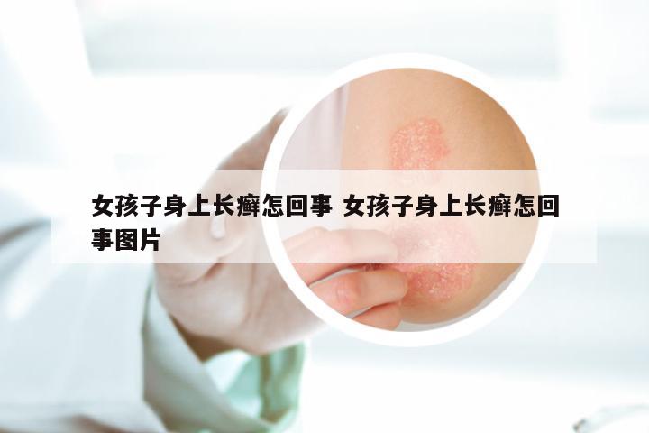 女孩子身上长癣怎回事 女孩子身上长癣怎回事图片