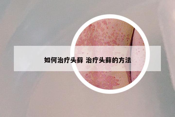 如何治疗头藓 治疗头藓的方法