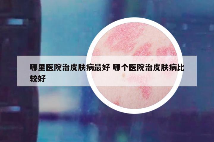 哪里医院治皮肤病最好 哪个医院治皮肤病比较好