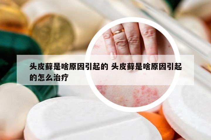 头皮藓是啥原因引起的 头皮藓是啥原因引起的怎么治疗