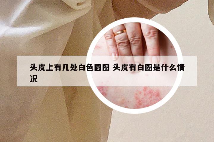 头皮上有几处白色圆圈 头皮有白圈是什么情况