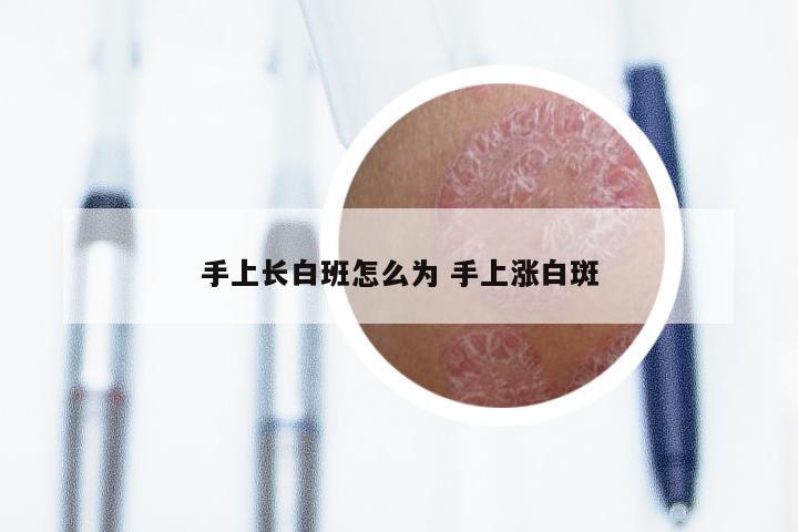 手上长白班怎么为 手上涨白斑