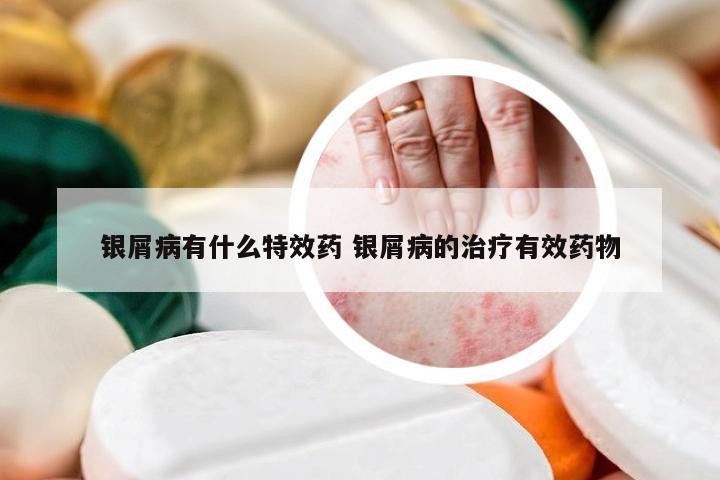 银屑病有什么特效药 银屑病的治疗有效药物