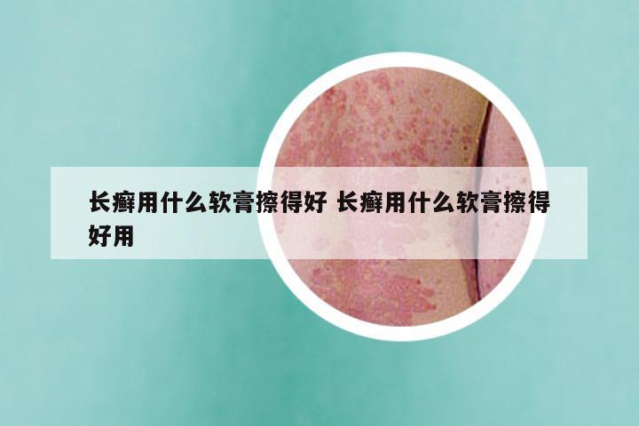 长癣用什么软膏擦得好 长癣用什么软膏擦得好用